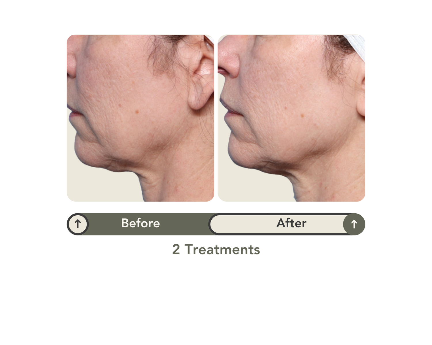 Curiva Med Spa XERF Neck Before After