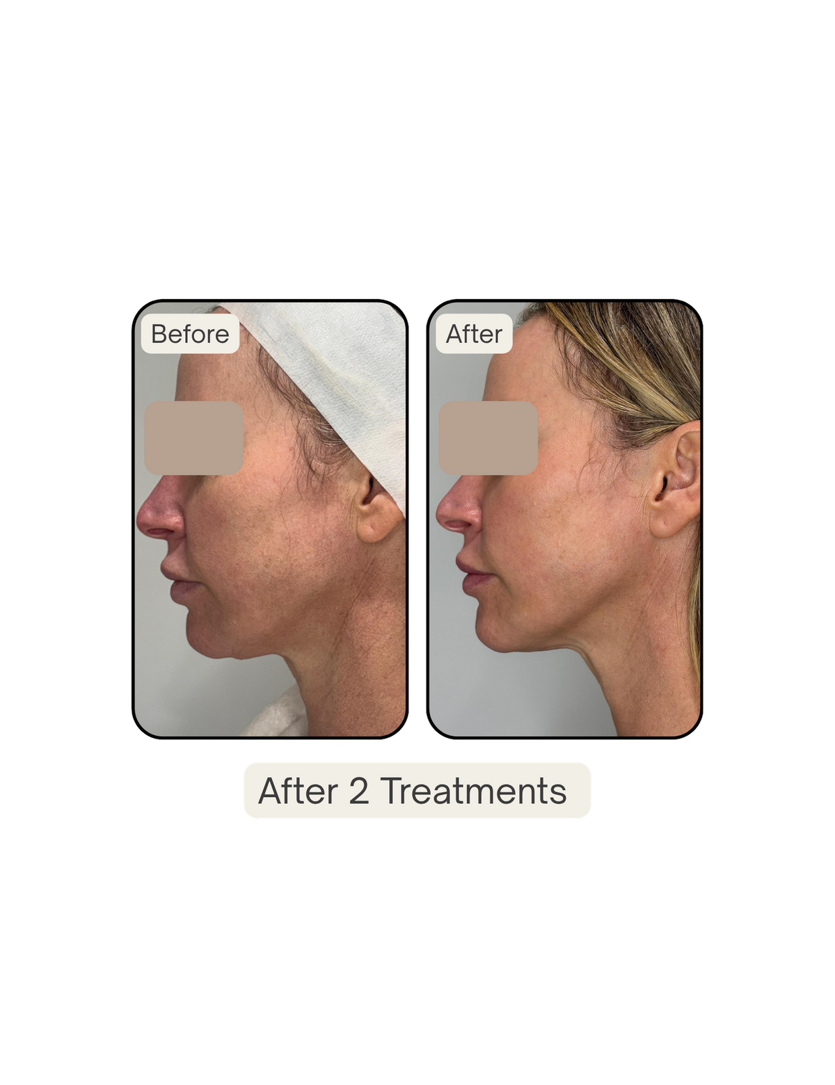 XERF Structural Skin Tightening in Los Angeles, CA – Curiva Med Spa