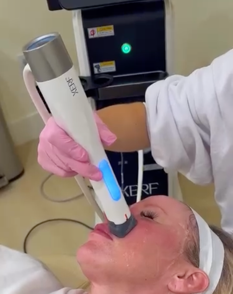 The Future of Structural Skin Tightening with XERF in Los Angeles, CA